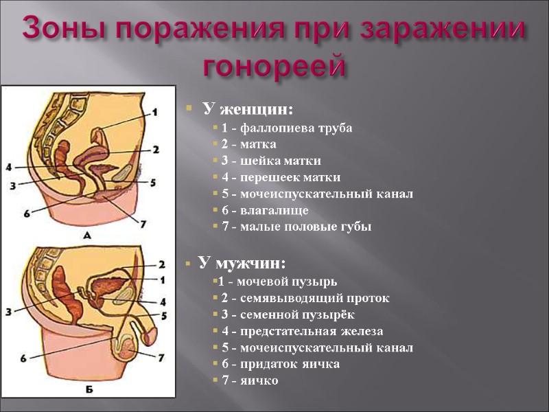 Зоны поражения при заражении гонореей    У женщин:  1 - фаллопиева